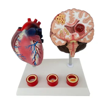 Az emberi szív-érrendszeri, valamint cerebrovascularis elzáródás kóros agyi vér, szív-érrendszeri elváltozás bemutató tanítás penész
