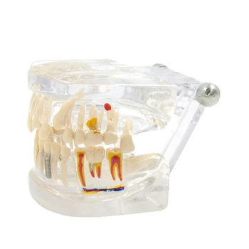 A fogászati Implantátum Modell Cserélhető Fogak 3.74 x 2,75 x 2.36 Hüvelykes Fogászati Tanítás